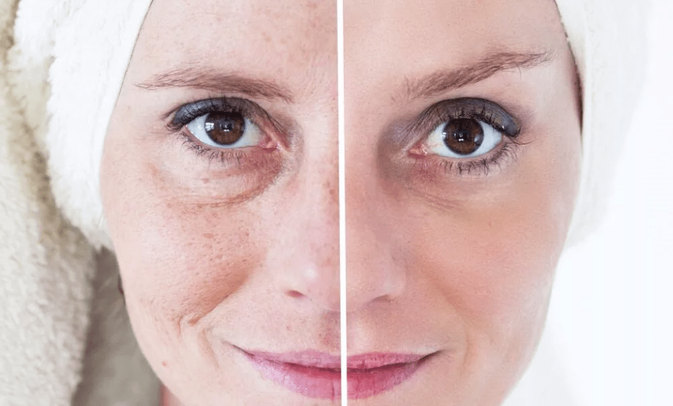 lézeres arcfiatalítás